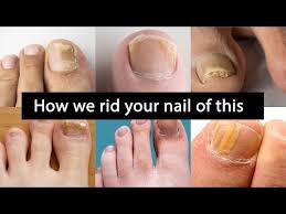 fungal nail treatment foot ankle