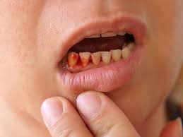 blood blister in mouth causes