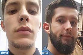 Loading beard's progress after 13 months of minoxidil application. Beardless Men Are Rubbing Hair Loss Drug On Their Face For Fuller Fuzz But Experts Warn It Could Fall Out
