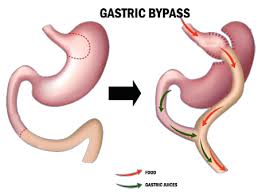 &nbsp;here in ny the total cost is about $21,000 including surgeon fee, anesthesia, and hospital fee. Perform Gastric Bypass Surgery Amitis Health Tourism Company
