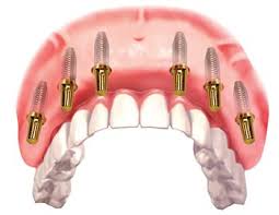 cost of dental implants bridge dental