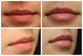demystifying lip injections here s
