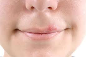 home remes for cold sores