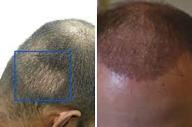 hair transplant after 1 month photos