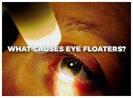 what causes eye floaters