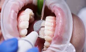 dental cleaning in la marque texas