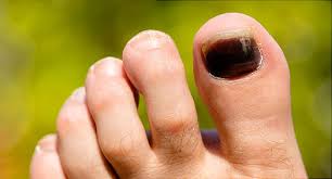 purple toenails causes prevention