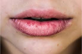 treat sunburned lips dgtl