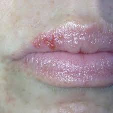cold sore treatment dr dan s lip