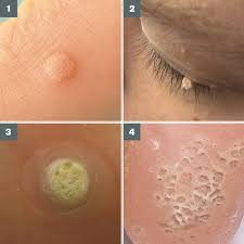 A lot of screaming and puke noises. Warts And Verrucas Assessment And Treatment Learning Article Pharmaceutical Journal