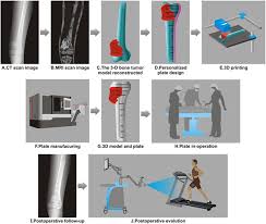 3d viewer is not available. 3d Printed Personalized Titanium Plates Improve Clinical Outcome In Microwave Ablation Of Bone Tumors Around The Knee Scientific Reports