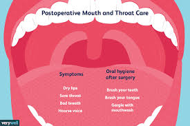 mouth and throat care after surgery
