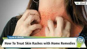 treat skin rashes with home remes