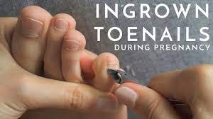 management for ingrown toenail east