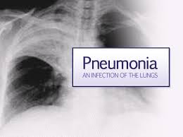 Image result for pneumonia