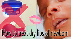 newborn dry lips how to treat ed