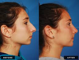 rhinoplasty nose job procedure