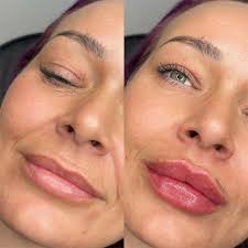 non surgical dermal lip fillers
