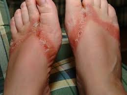 foot rash causes symptoms treatment
