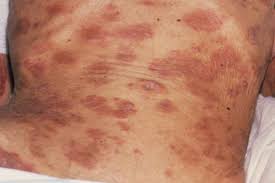 hiv aids skin conditions