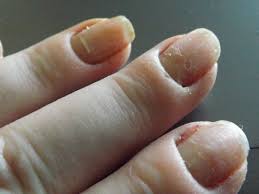 white spots in nails sue s pure nail