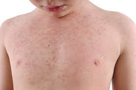 the 5 most common summertime rashes and