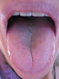 Ayurvedic Tongue Diagnosis Correspondence Course The
