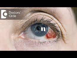causes of red clots in eyes dr mala