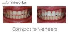 how-much-does-a-full-set-of-veneers-cost-uk