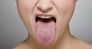 dry mouth its causes and potential
