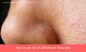 How to remove blackheads and whiteheads on nose ✦ dr laelia ✦ watch more: Top 18 Home Remedies For Whiteheads On Face And Nose