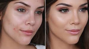to er acne and pimples with makeup