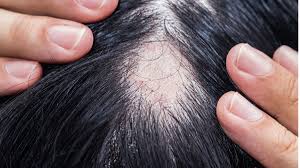 finasteride for hair loss how to save