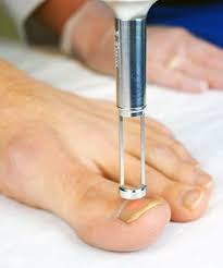 ingrowing toe nail removal primary