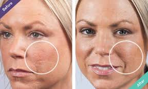 home remes for acne scars