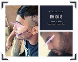 If you are an ftm transgender guy who has started hormone replacement therapy, you might be wondering if you will be able to grow facial hair. Ftm Transgender Beard Transplant Neda Transgender Surgery