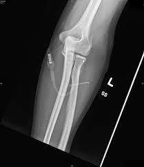 A medial epicondyle fracture is an avulsion injury of the attachment of the common flexors of the forearm. Lateral Epicondyle Fracture Jetem