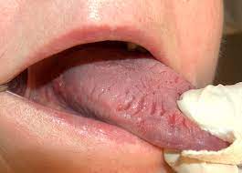 tongue s symptoms and causes