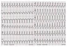 Image result for icd 10 code for wide qrs rhythm