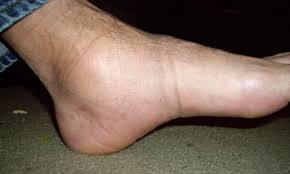 ankle after plaster cast removal