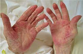 Palmar erythema may occur in about 30 to 60 percent of pregnant people. Palmar Erythema As A Sign Of Cancer Cleveland Clinic Journal Of Medicine