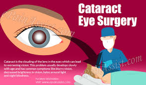 Cataract Eye Surgery What To Expect Dos Donts Dry Eye