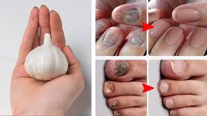 garlic to heal your toenail fungus at