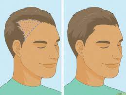 how to regrow hair can natural