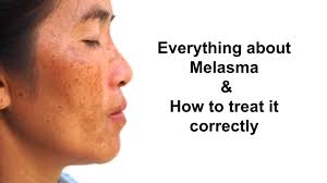 melasma treatment in singapore the