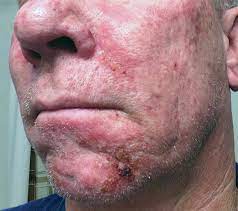 actinic keratosis