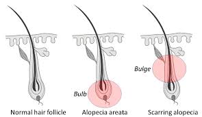 hair loss and the new cosmeceutical