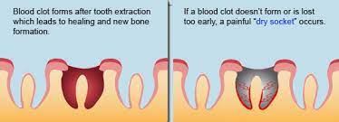 tooth extractions encinitas ca