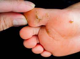 plantar warts foot specialist toronto