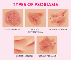 Stress, alcohol, and other triggers. The Ultimate Guide To Psoriasis What Causes It And How To Treat It Blog Huda Beauty
